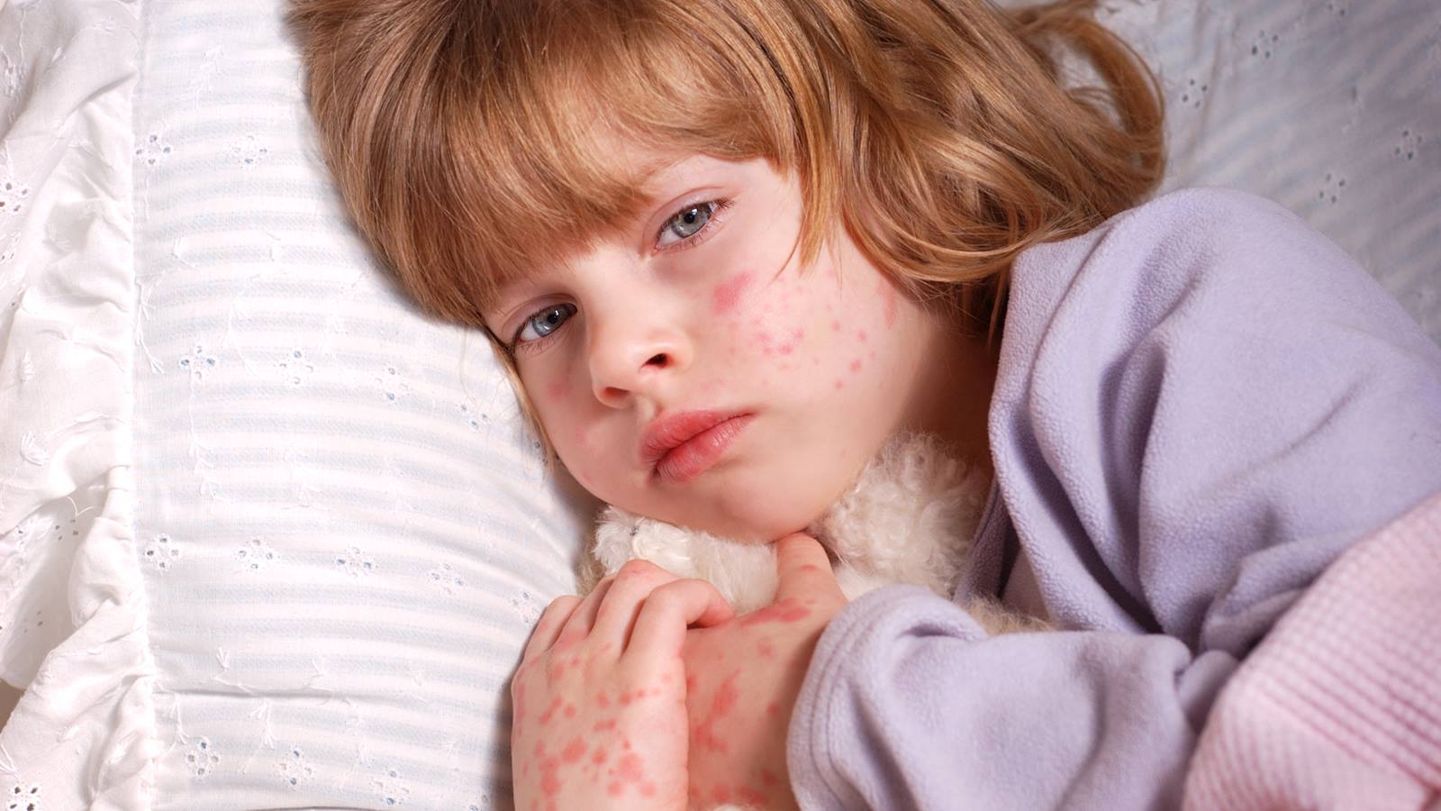 Rash in children. We analyze the reasons