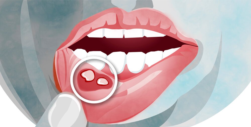 What is stomatitis