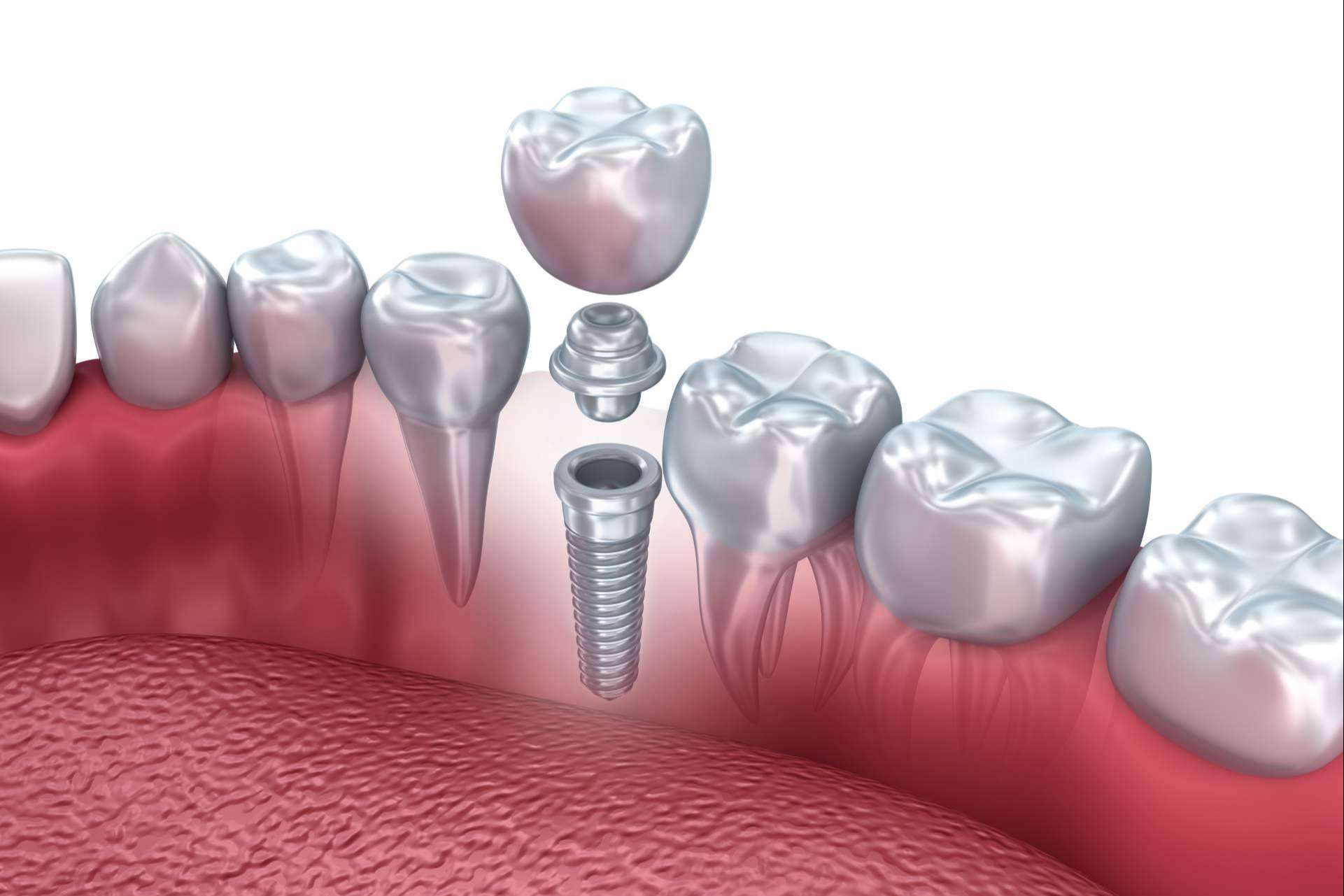 Cleaning of crowns and implants